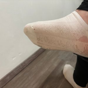 Socken Nach Operation